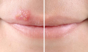 Koortslip Lip met een koortslip