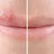SoreFix behandelen